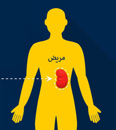 مريض بحاجة لزراعة الكلى
